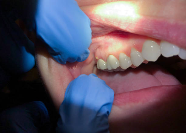 Best Emergency Tooth Extraction in Sanford, FL