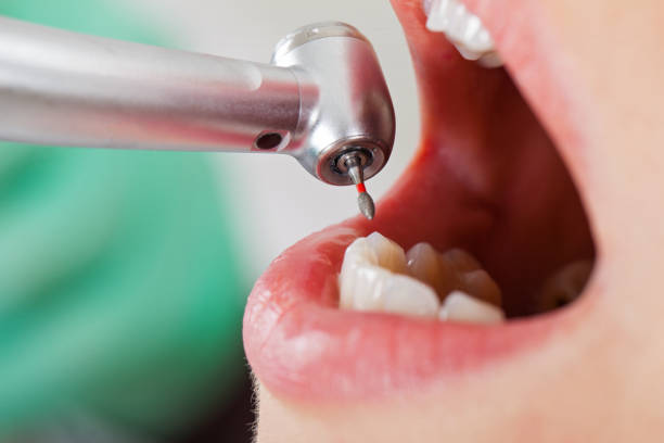 Best Emergency Tooth Extraction in Sanford, FL
